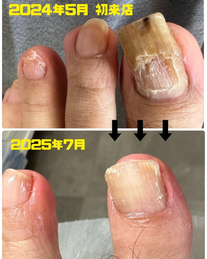 何年も皮膚科に通って薬を塗り続けても治らなかったお客様。しっかり削りプレートやジェルで補強する事…