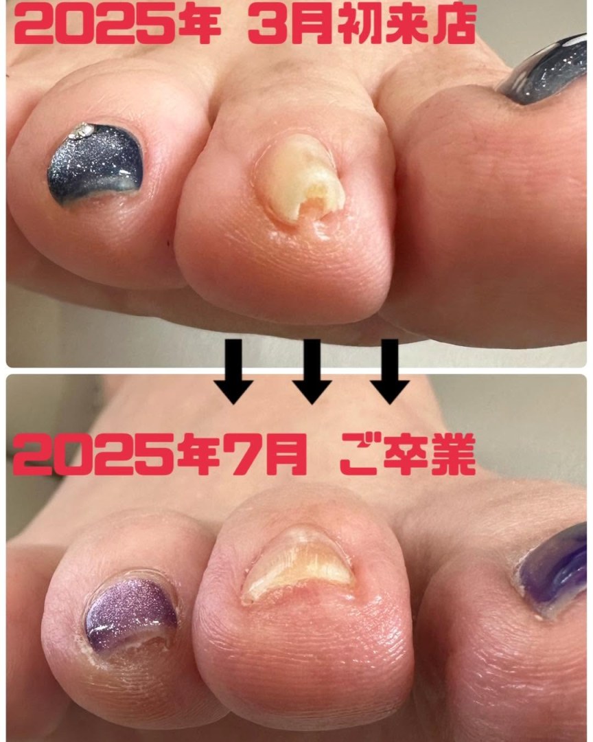 親指以外の爪もプレート装着可能です✨ 親指以外は比較的早めに矯正終了される方が多いです!! In…